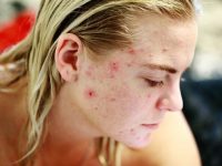 Inherited Skin Conditions